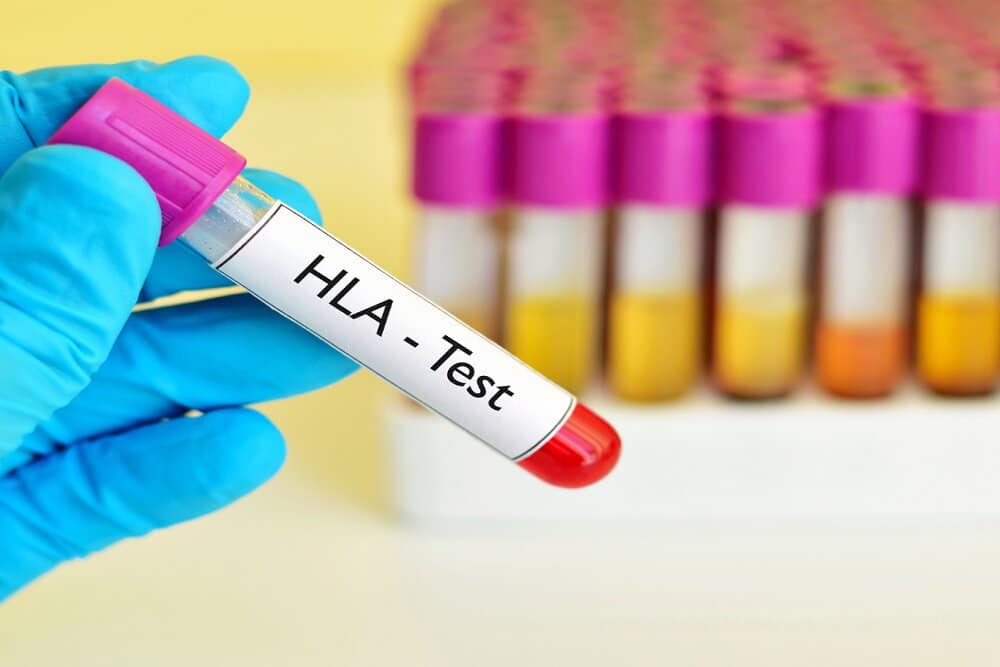 ضرورت توجه به قومیت‌ها برای تقویت بانک اطلاعاتی HLA جهت پیوند سلول‌های بنیادی