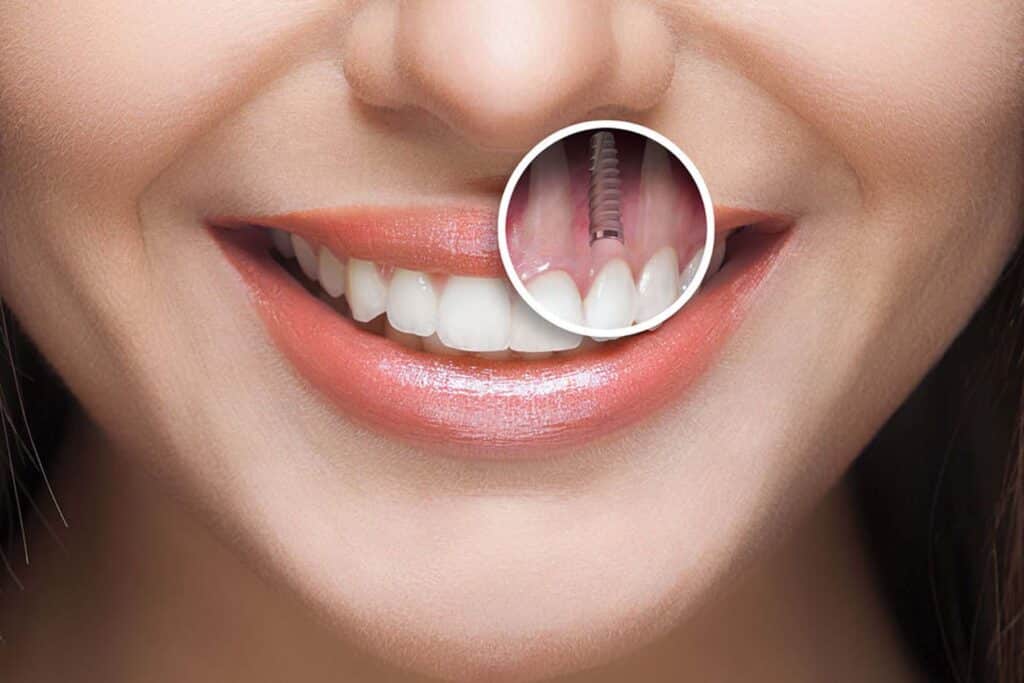 نکات مهم در  مرکز و متخصص ایمپلنت
