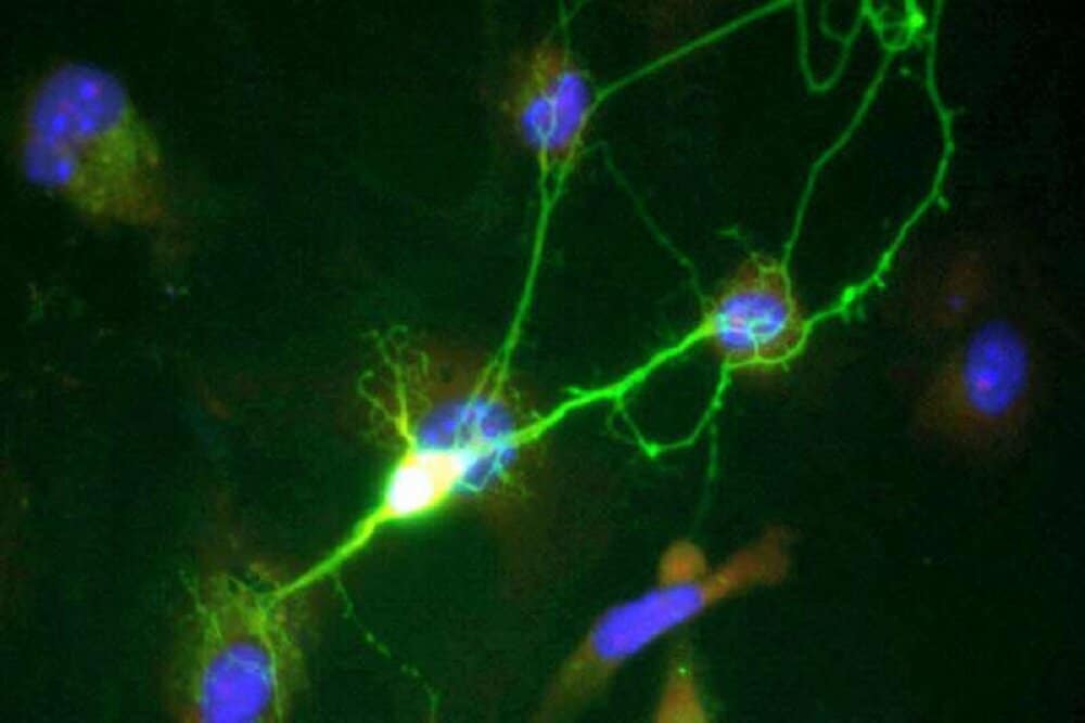 جلوگیری از مرگ نورون‌ها در آلزایمر با یک داروی رایج